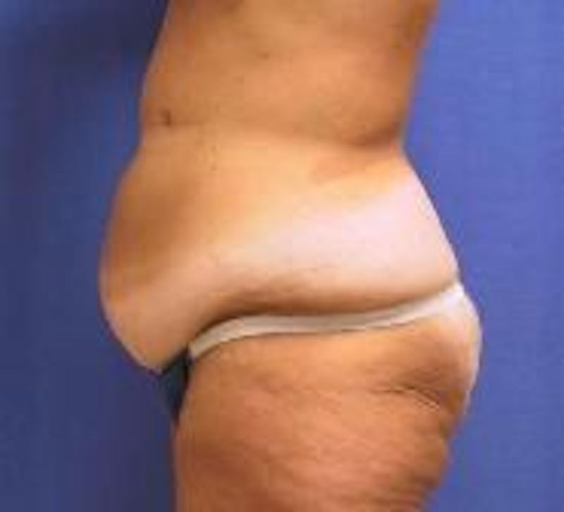 Tummy Tuck Before & After Gallery - Patient 89987856 - Image 5