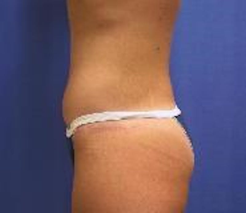 Tummy Tuck Before & After Gallery - Patient 89987856 - Image 6