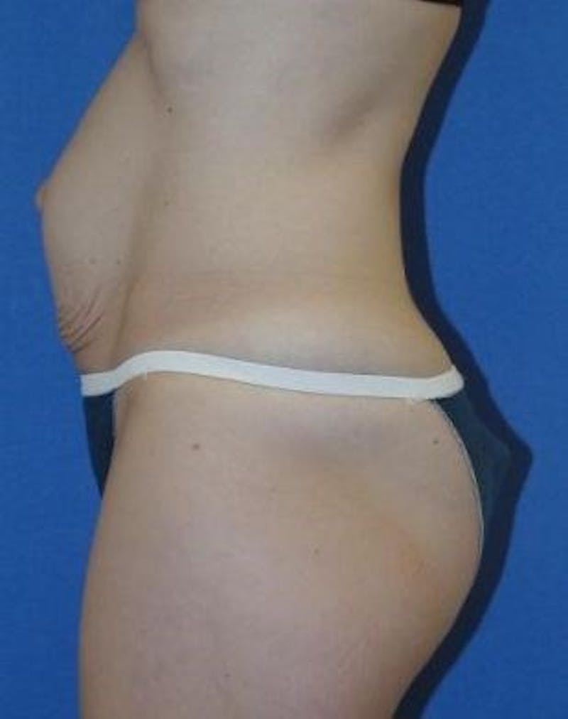 Tummy Tuck Before & After Gallery - Patient 89987857 - Image 1