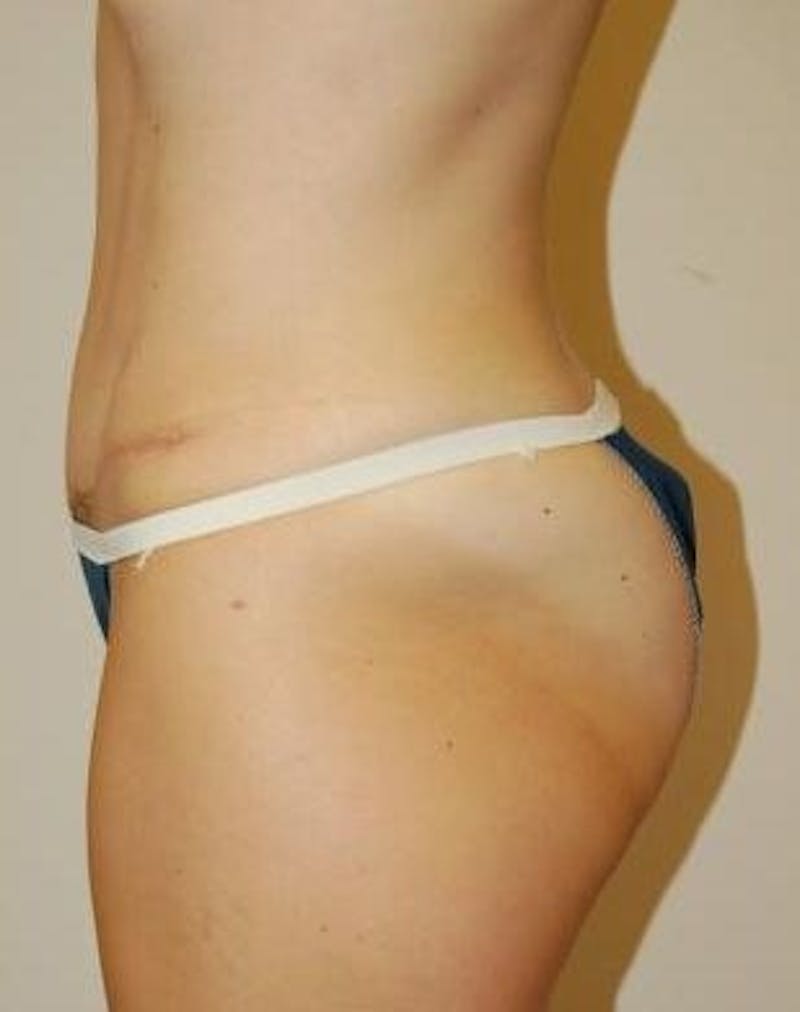 Tummy Tuck Before & After Gallery - Patient 89987857 - Image 2