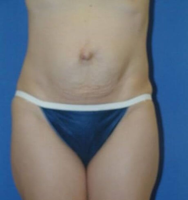 Tummy Tuck Before & After Gallery - Patient 89987857 - Image 3