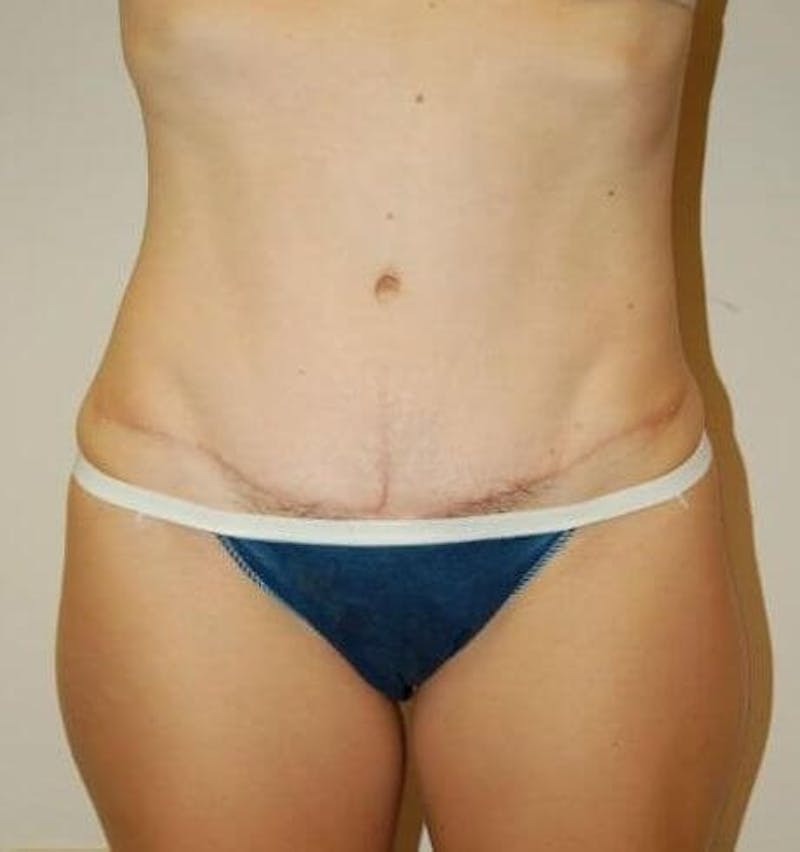 Tummy Tuck Before & After Gallery - Patient 89987857 - Image 4