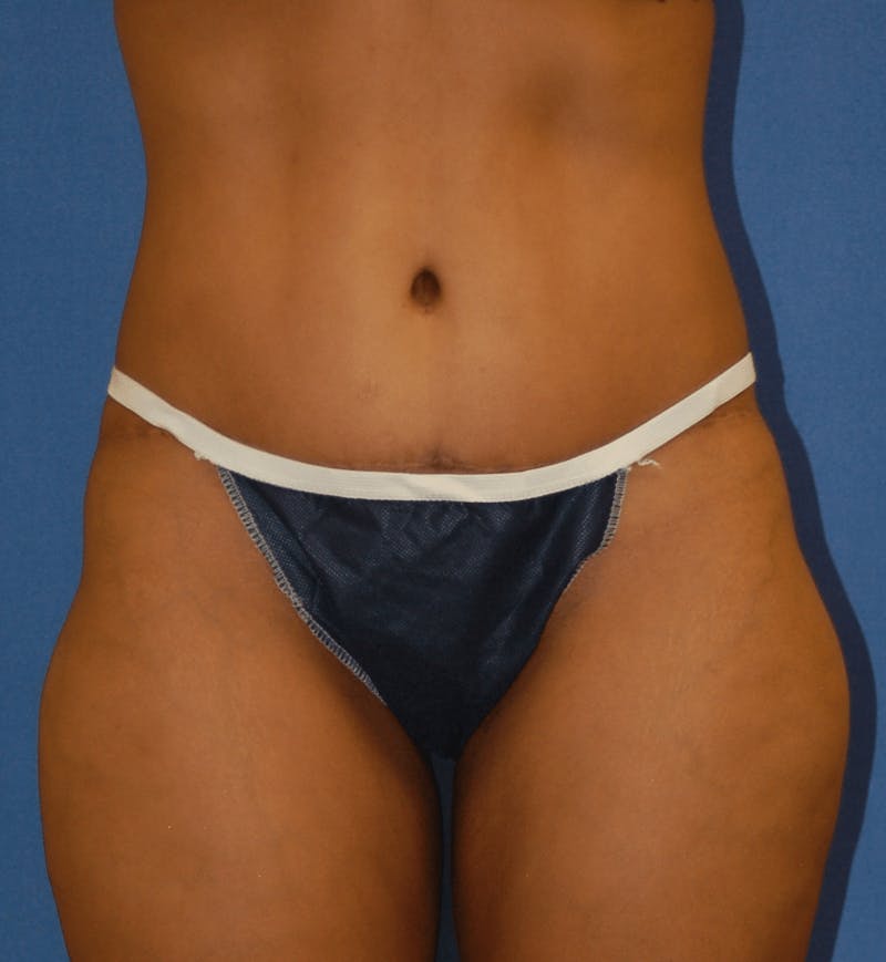 Tummy Tuck Before & After Gallery - Patient 89987865 - Image 2