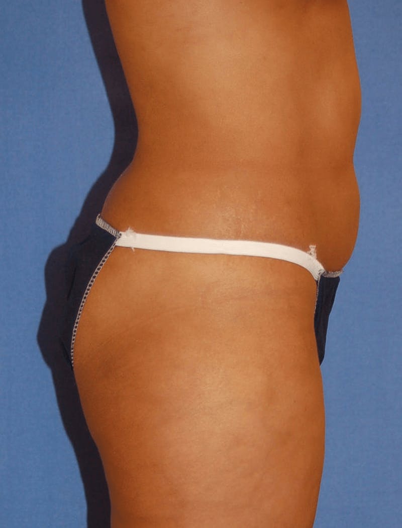 Tummy Tuck Before & After Gallery - Patient 89987865 - Image 3