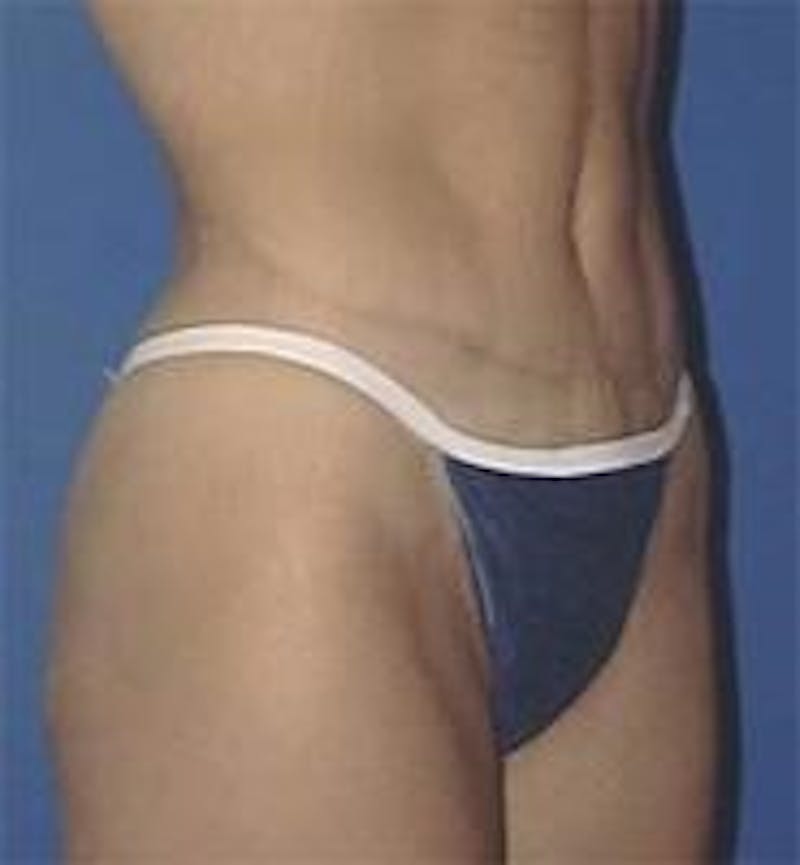 Tummy Tuck Before & After Gallery - Patient 89987866 - Image 2