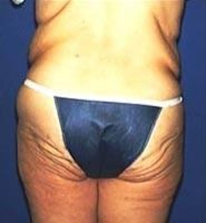 Tummy Tuck Before & After Gallery - Patient 89987866 - Image 5