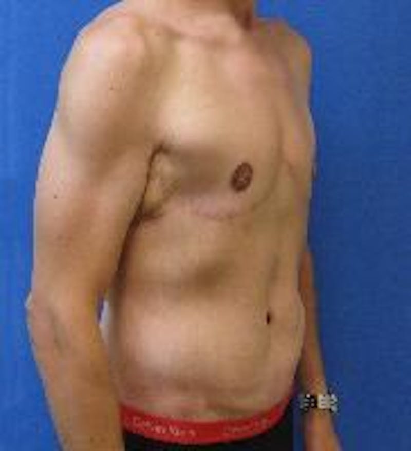 Tummy Tuck Before & After Gallery - Patient 89987867 - Image 2