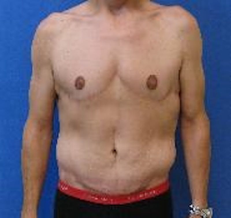 Tummy Tuck Before & After Gallery - Patient 89987867 - Image 4