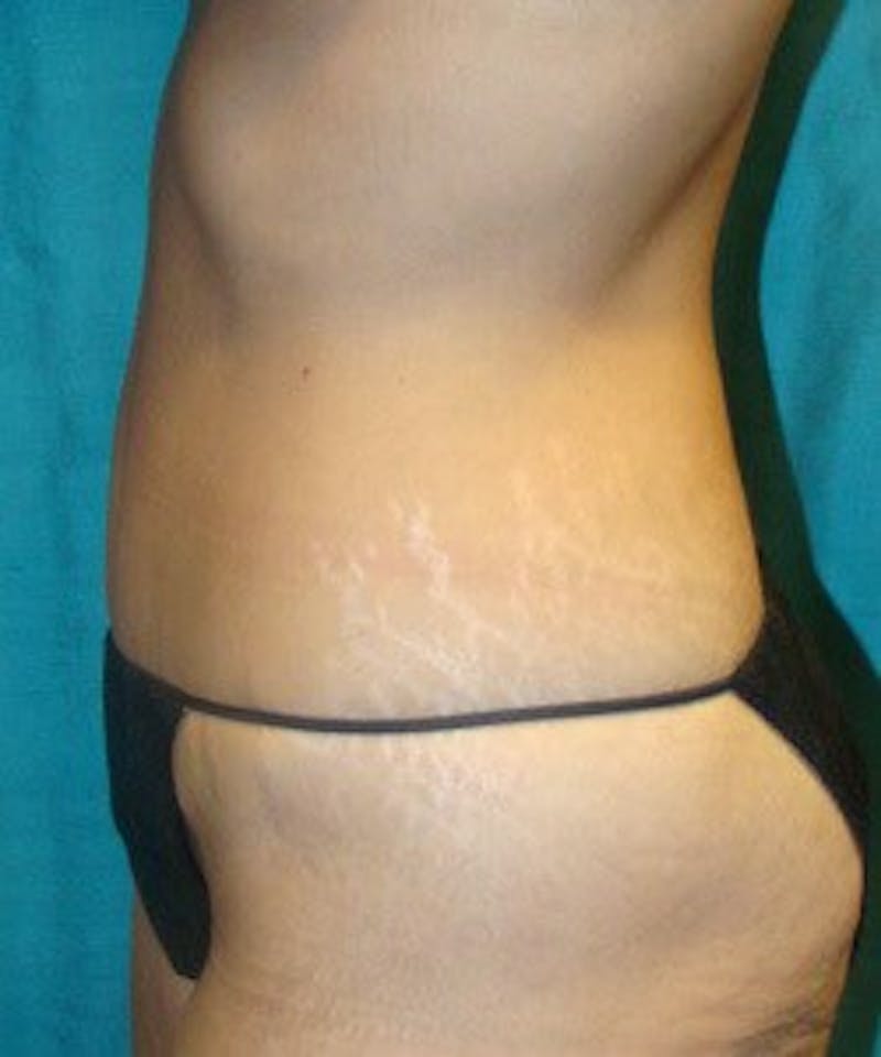 Tummy Tuck Before & After Gallery - Patient 89987868 - Image 2