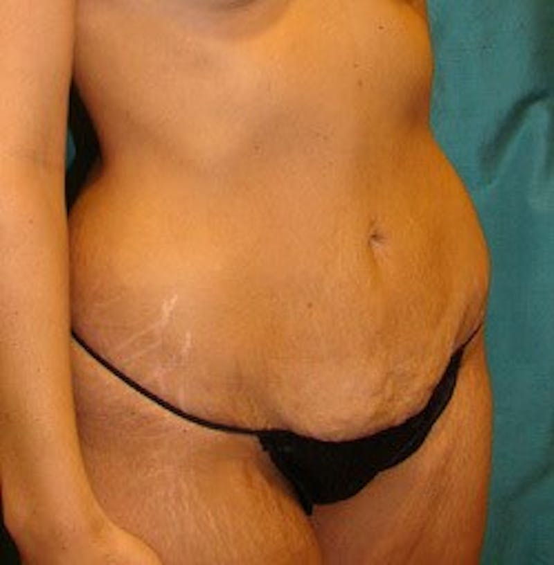 Tummy Tuck Before & After Gallery - Patient 89987868 - Image 3