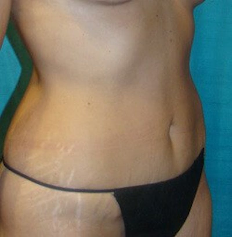 Tummy Tuck Before & After Gallery - Patient 89987868 - Image 4