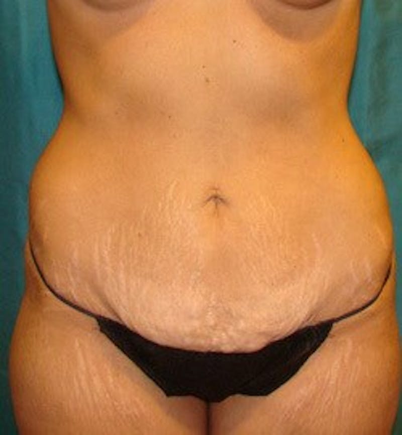 Tummy Tuck Before & After Gallery - Patient 89987868 - Image 5