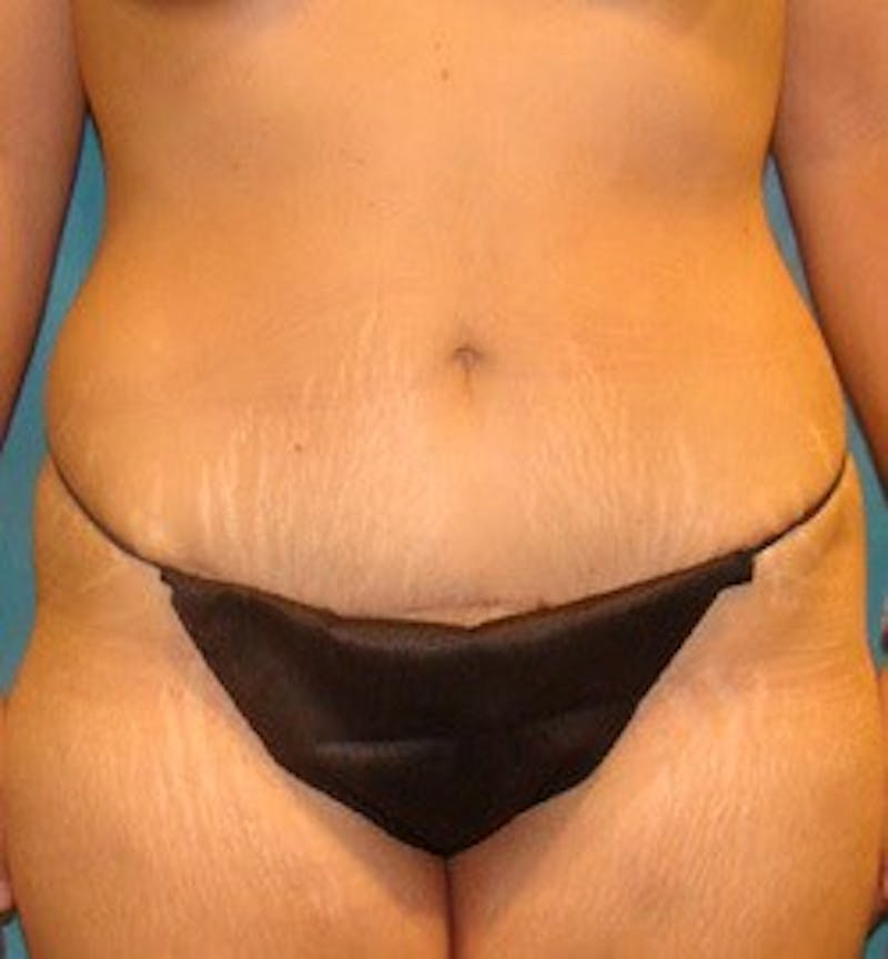 Tummy Tuck Before & After Gallery - Patient 89987868 - Image 6