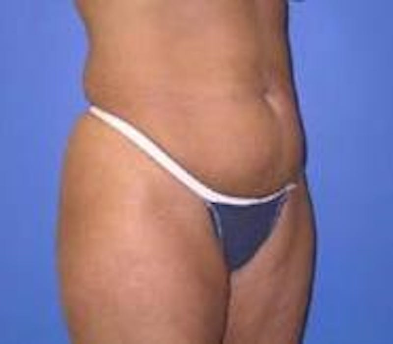 Tummy Tuck Before & After Gallery - Patient 89987869 - Image 1