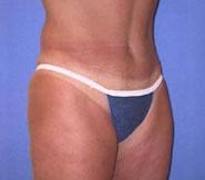 Tummy Tuck Before & After Gallery - Patient 89987869 - Image 2