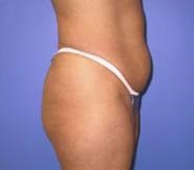 Tummy Tuck Before & After Gallery - Patient 89987869 - Image 3