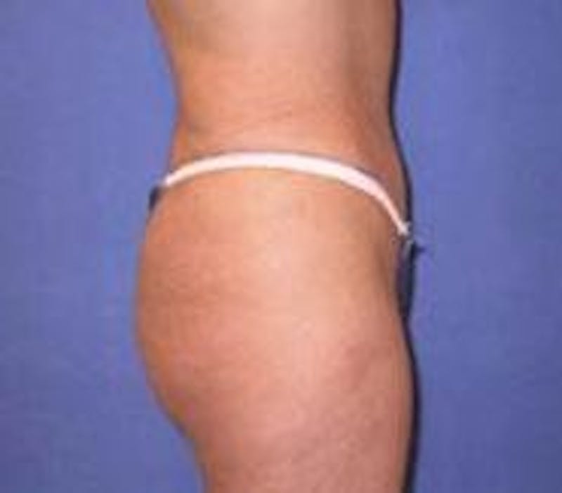 Tummy Tuck Before & After Gallery - Patient 89987869 - Image 4