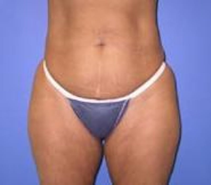 Tummy Tuck Before & After Gallery - Patient 89987869 - Image 5