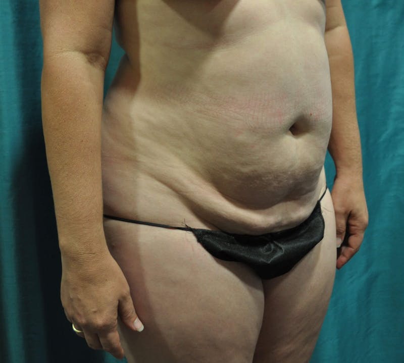 Tummy Tuck Before & After Gallery - Patient 89987886 - Image 1