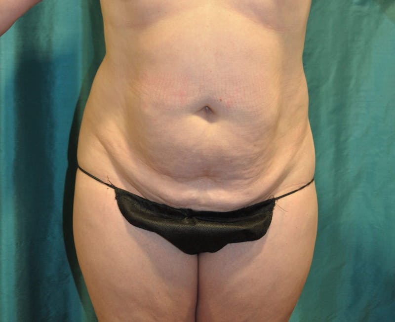 Tummy Tuck Before & After Gallery - Patient 89987886 - Image 3