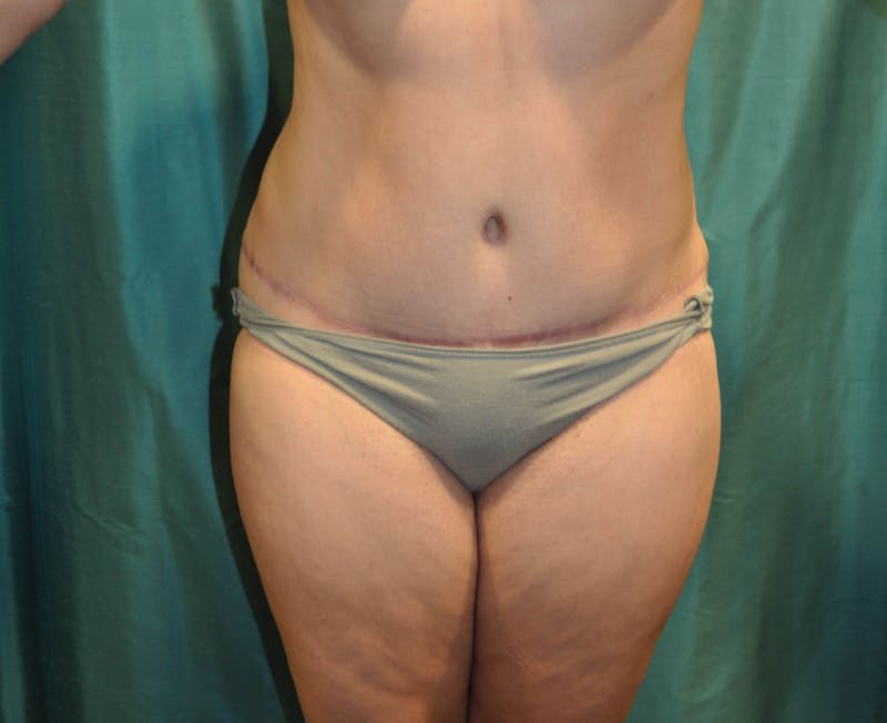 Tummy Tuck Before & After Gallery - Patient 89987886 - Image 4