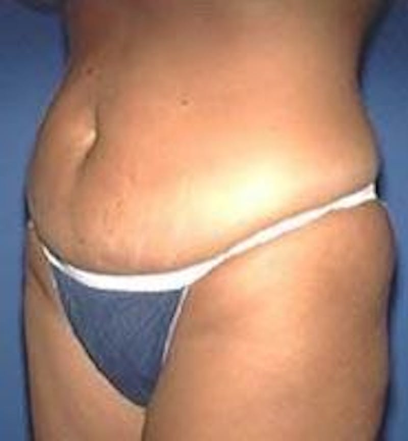 Tummy Tuck Before & After Gallery - Patient 89987890 - Image 1