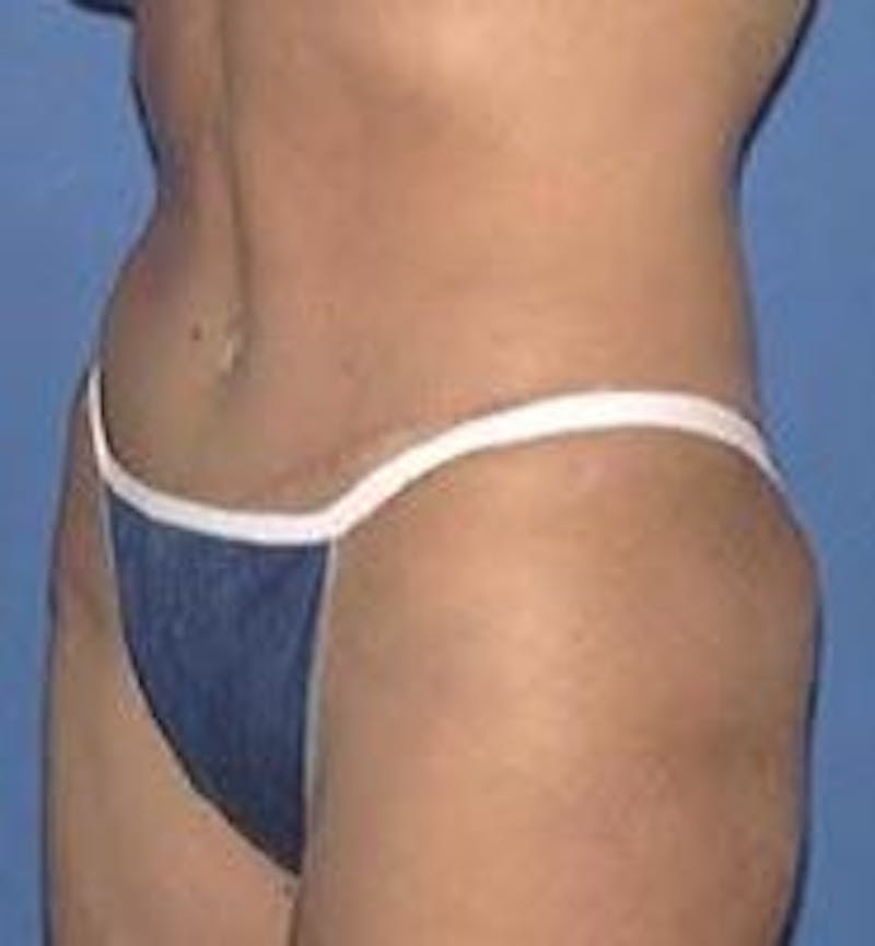 Tummy Tuck Before & After Gallery - Patient 89987890 - Image 2