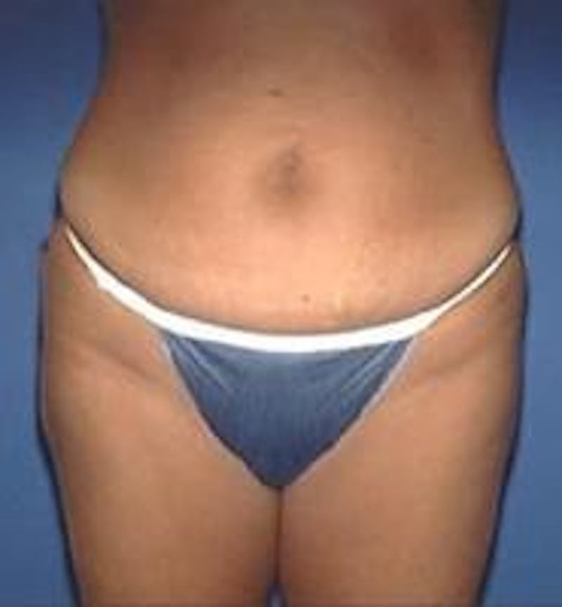 Tummy Tuck Before & After Gallery - Patient 89987890 - Image 3