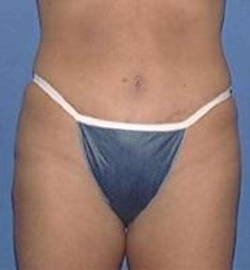 Tummy Tuck Before & After Gallery - Patient 89987890 - Image 4