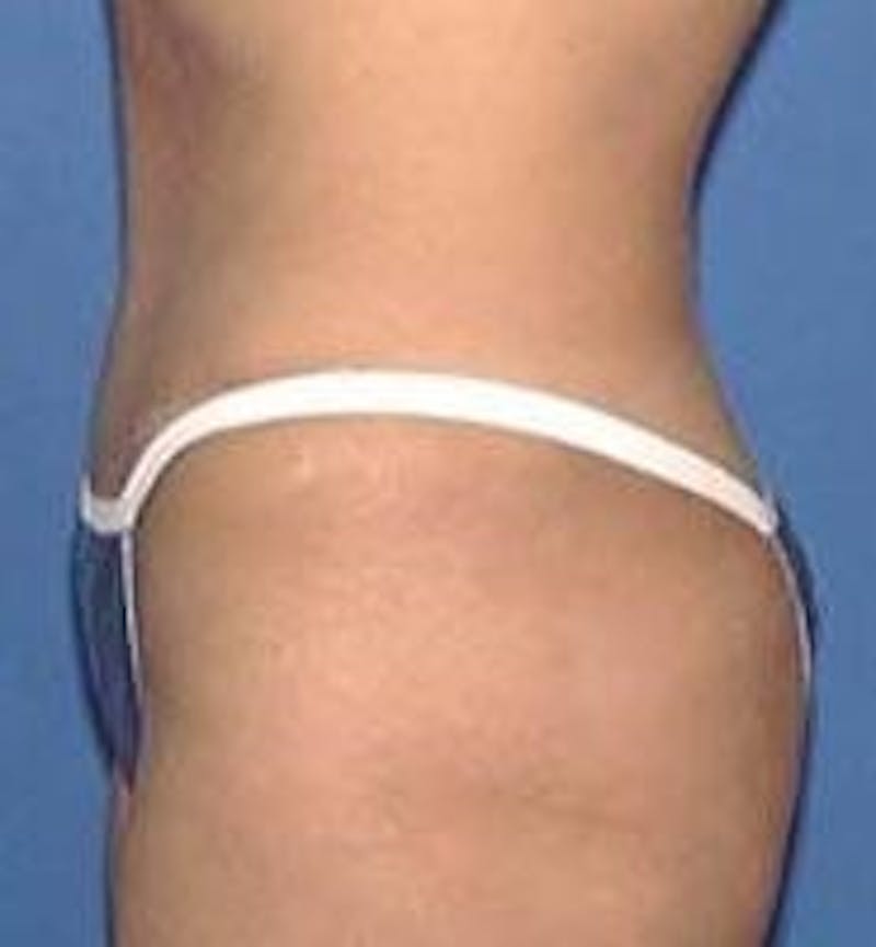 Tummy Tuck Before & After Gallery - Patient 89987890 - Image 6
