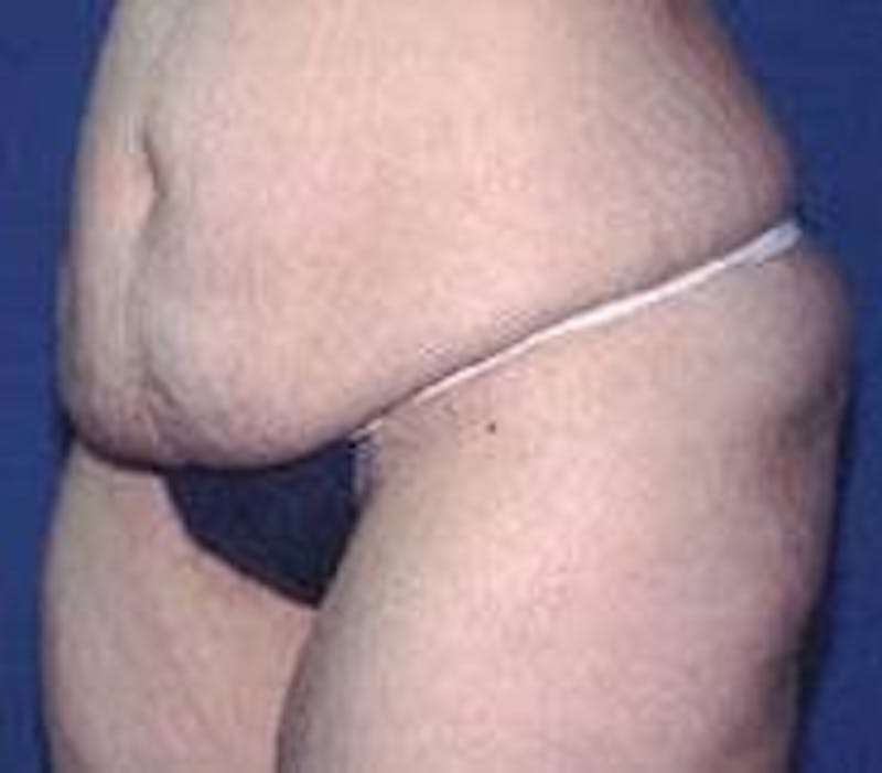 Tummy Tuck Before & After Gallery - Patient 89987893 - Image 1
