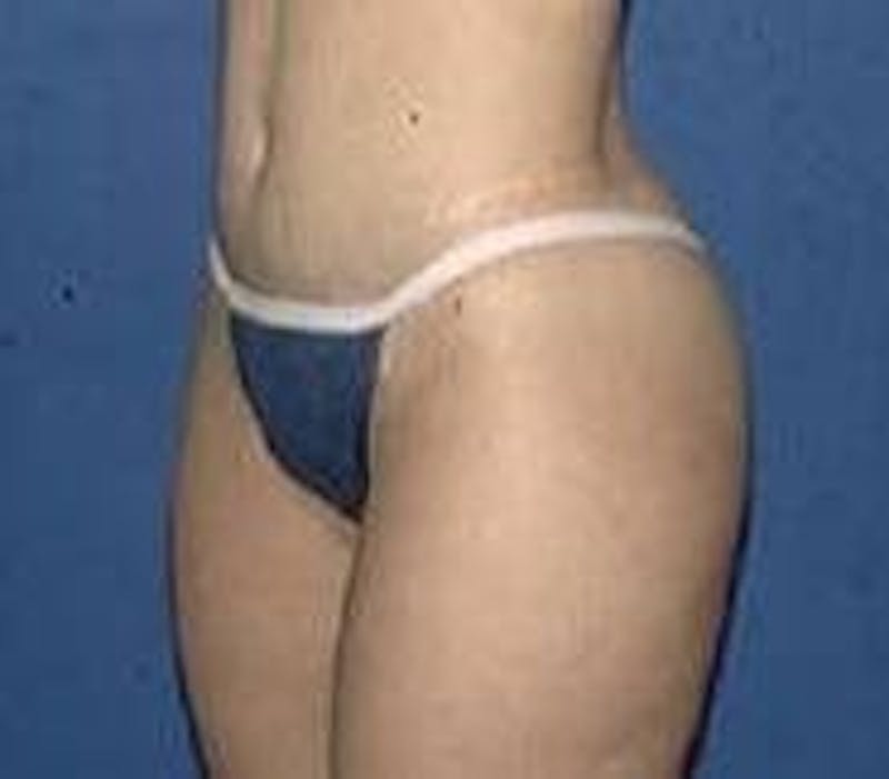 Tummy Tuck Before & After Gallery - Patient 89987893 - Image 2