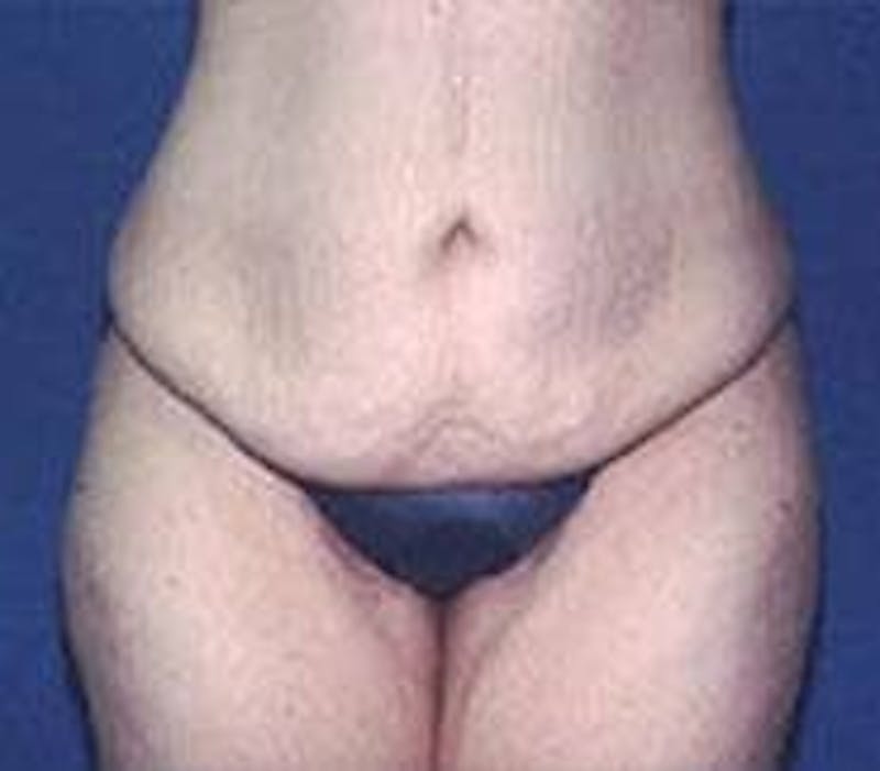 Tummy Tuck Before & After Gallery - Patient 89987893 - Image 3