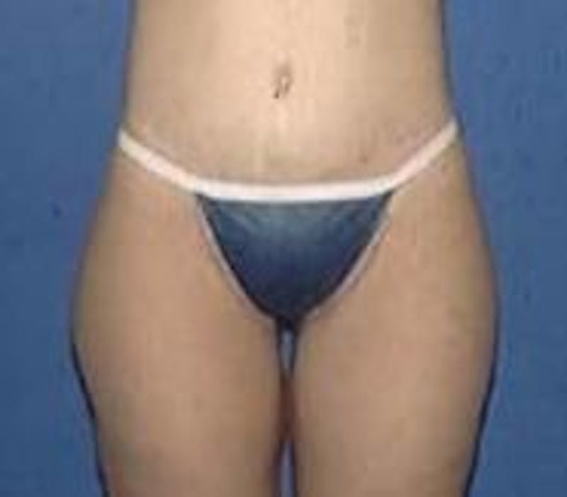 Tummy Tuck Before & After Gallery - Patient 89987893 - Image 4
