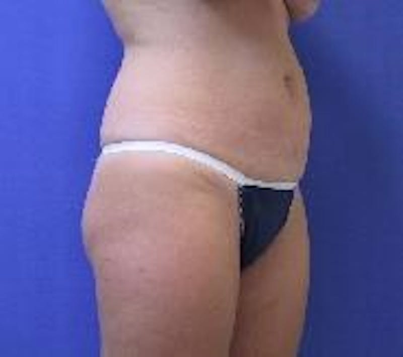 Tummy Tuck Before & After Gallery - Patient 89987894 - Image 1