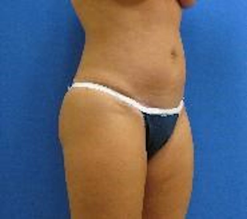 Tummy Tuck Before & After Gallery - Patient 89987894 - Image 2