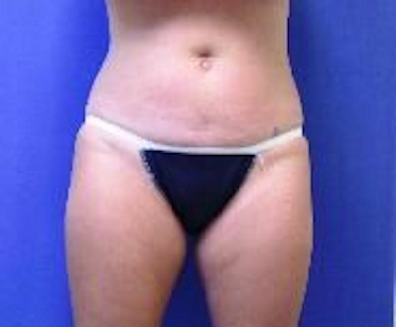 Tummy Tuck Before & After Gallery - Patient 89987894 - Image 3