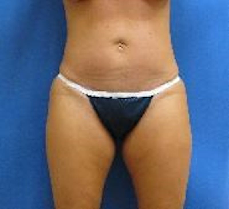 Tummy Tuck Before & After Gallery - Patient 89987894 - Image 4