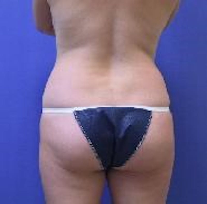 Tummy Tuck Before & After Gallery - Patient 89987894 - Image 5