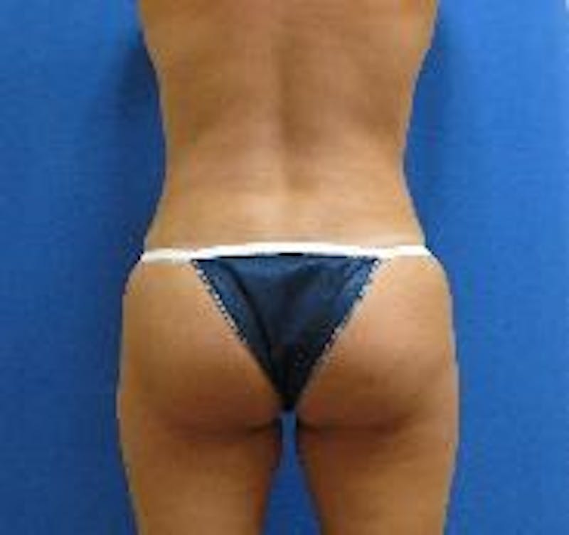 Tummy Tuck Before & After Gallery - Patient 89987894 - Image 6