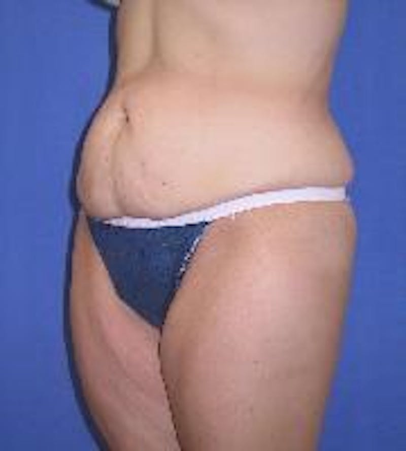 Tummy Tuck Before & After Gallery - Patient 89987895 - Image 1