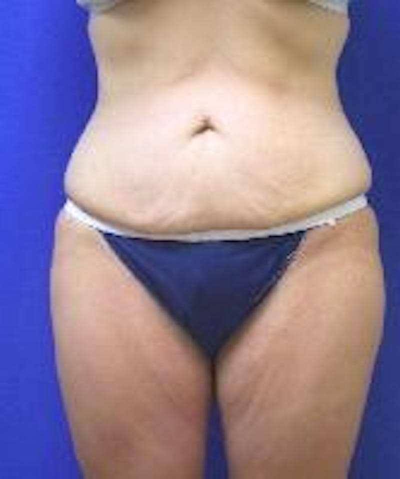 Tummy Tuck Before & After Gallery - Patient 89987895 - Image 3
