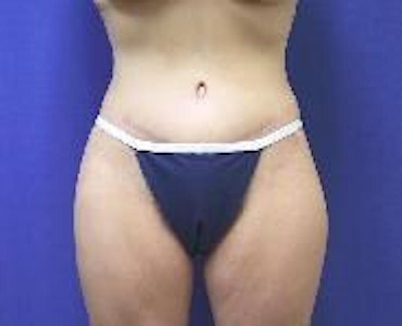 Tummy Tuck Before & After Gallery - Patient 89987895 - Image 4