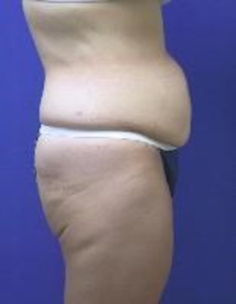 Tummy Tuck Before & After Gallery - Patient 89987895 - Image 5
