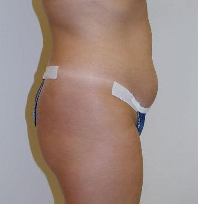 Tummy Tuck Before & After Gallery - Patient 89987955 - Image 1
