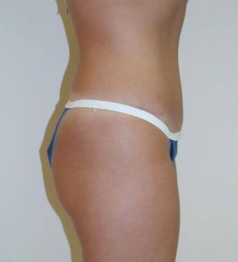 Tummy Tuck Before & After Gallery - Patient 89987955 - Image 2
