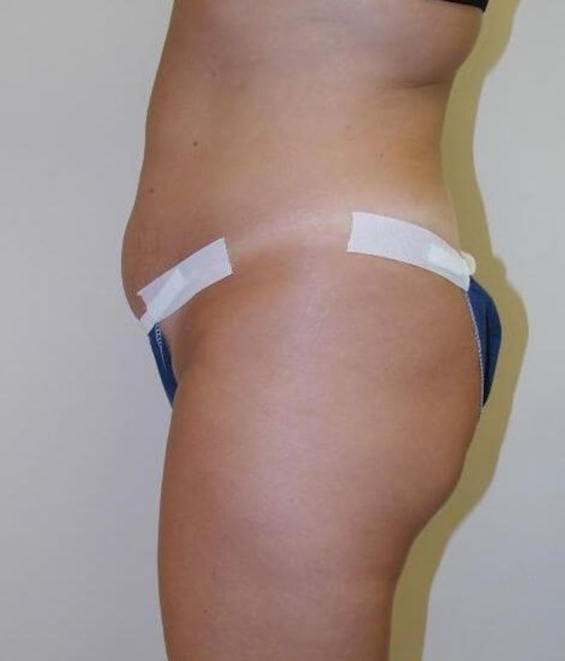 Tummy Tuck Before & After Gallery - Patient 89987955 - Image 3