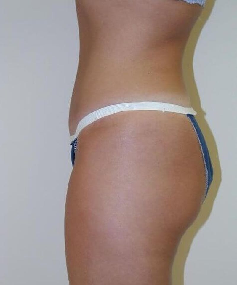 Tummy Tuck Before & After Gallery - Patient 89987955 - Image 4