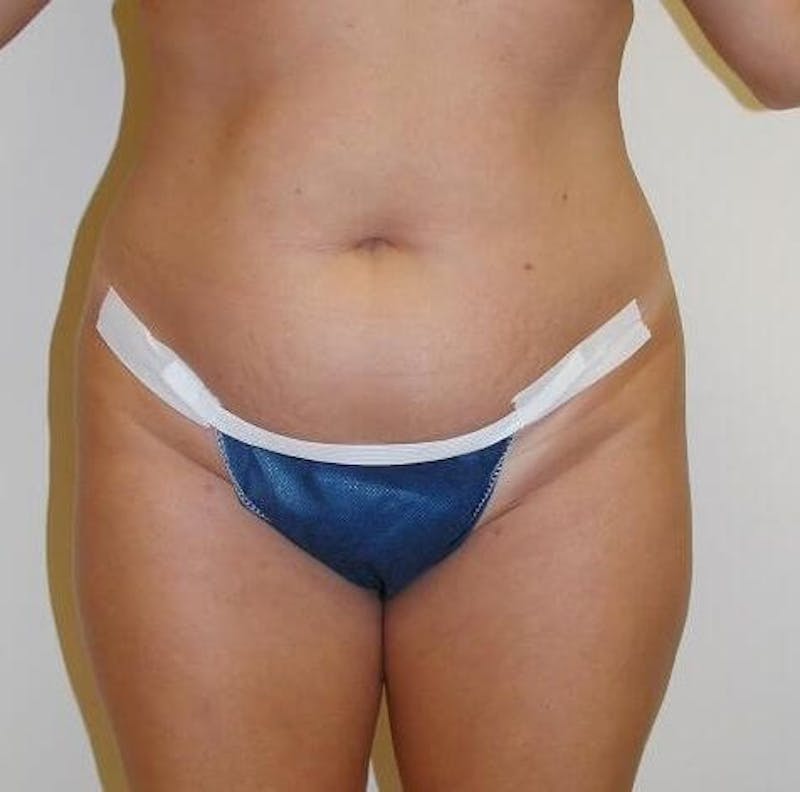 Tummy Tuck Before & After Gallery - Patient 89987955 - Image 5