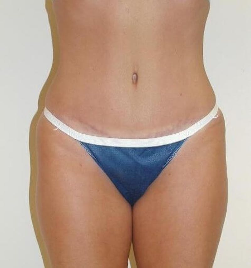 Tummy Tuck Before & After Gallery - Patient 89987955 - Image 6